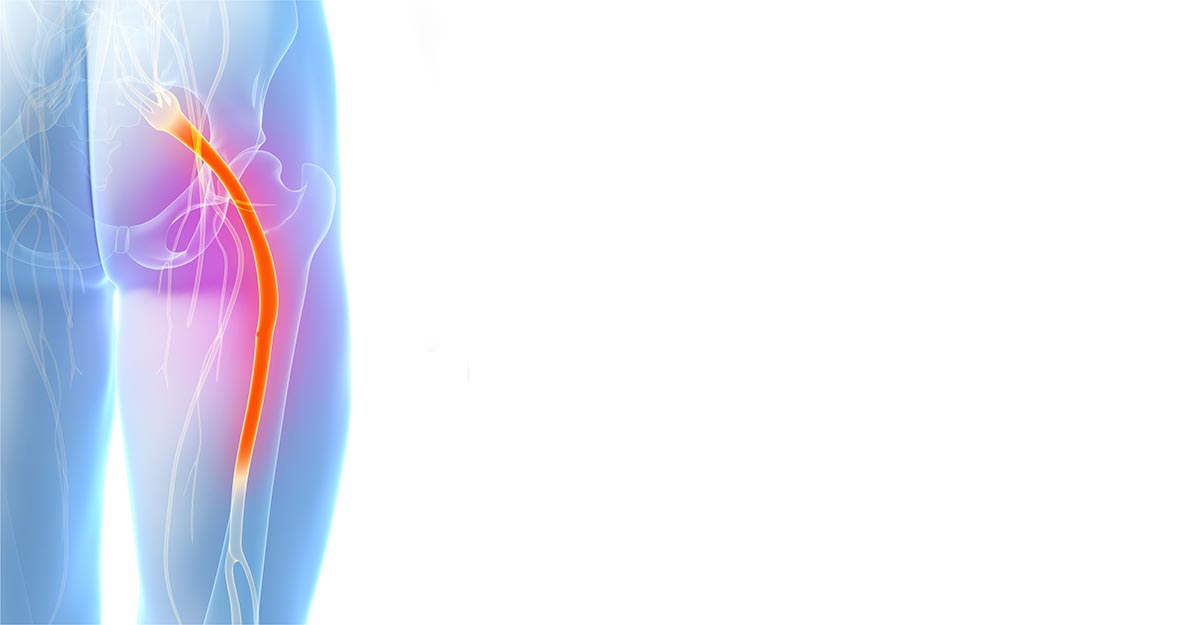 Jacksonville sciatica treatment and chiropractic