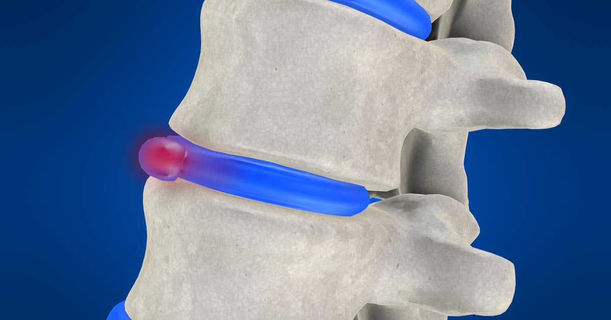 Jacksonville, FL non-surgical disc herniation treatment